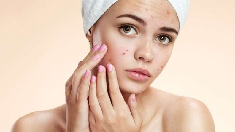 Mụn trứng cá hình thành có thể do nội tiết tố trong cơ thể thay đổi, rối loạn tiêu hóa