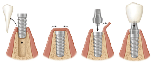 dental-implant-procedure.jpg