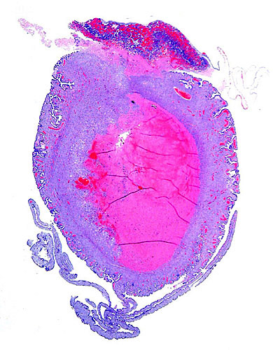 Placental disk at top, mass of invaded trophoblast in endometrium and degenerating edge of subplacenta and decidua.