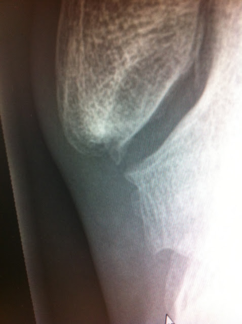 Ankle.JPG