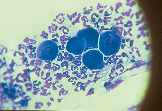 Acantholytic cells on an aspirate of an intact pustule from a dog with pemphigus foliaceus stained with DiffQuick (original magnification x1000)