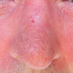 Once nose recovered Aldara treatment recommenced