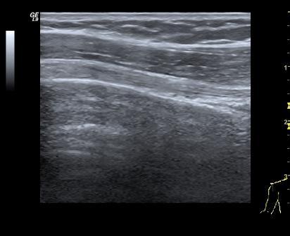 Biceps longitudinal 