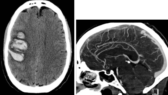 Imagem 3. Tomografia computadorizada do crânio sem contraste (imagem da direita) e angiotomografia venosa do crânio (imagem da esquerda) evidenciando hemorragias parenquimatosas no hemisférios cerebral direito (imagem da direita) decorrente de uma extensa trombose do seio sagital superior (imagem da esquerda). Fonte: Gaillard, F. 