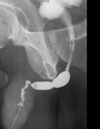 O papel da radiografia contrastada na avaliação das lesões uretrais 