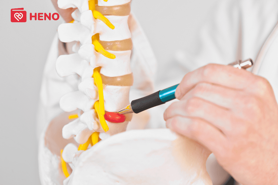 thoát vị cột sống thắt lưng là bệnh lý về cơ xương khớp thường thấy ở dân văn phòng