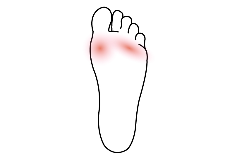 Pain Ball Of Foot Cause Of Pain In The Ball Of Foot