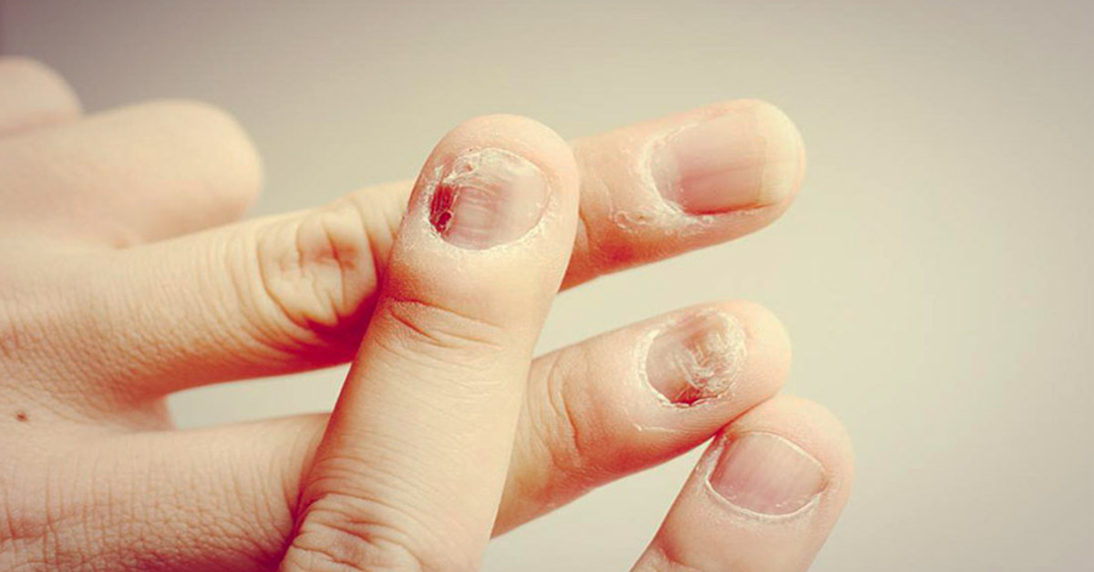 Nấm móng tay là căn bệnh nguyên nhân chủng nấm tạo nên làm mất đi thẩm mỹ và làm đẹp nguy hiểm cho những vùng móng tay