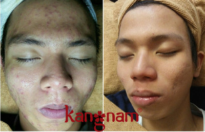 Viên uống trị mụn Murad review