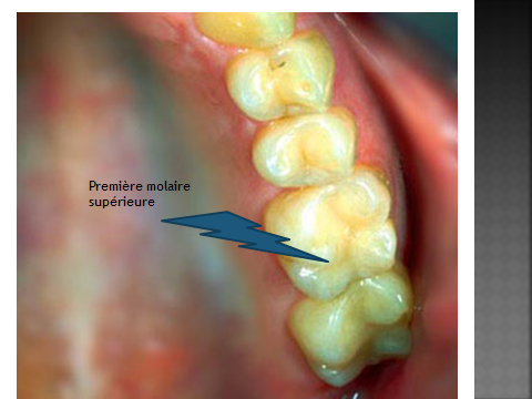 Les molaires supérieures