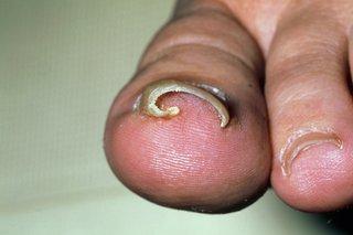 A toenail curving into the big toe.