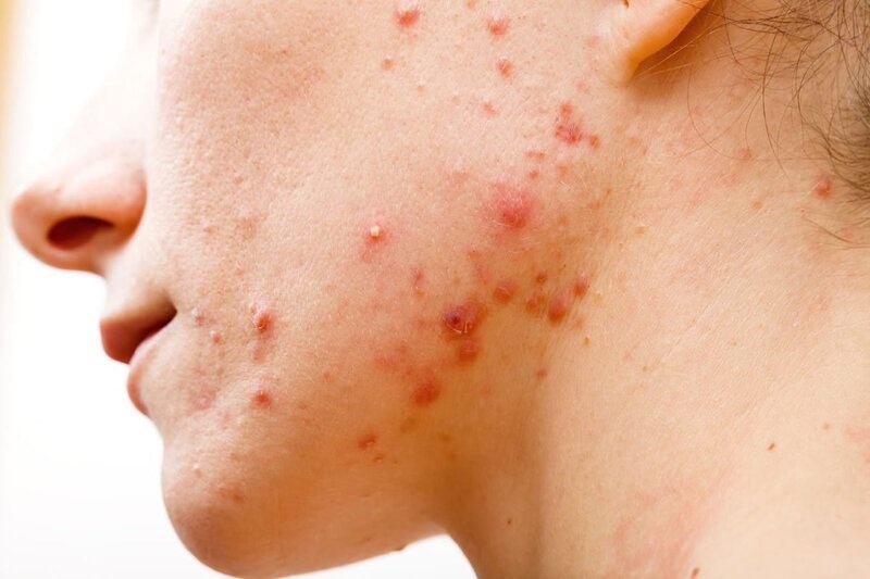 Chăm sóc da mụn rất cần thiết để có làn da khỏe đẹp, giảm mụn viêm sưng