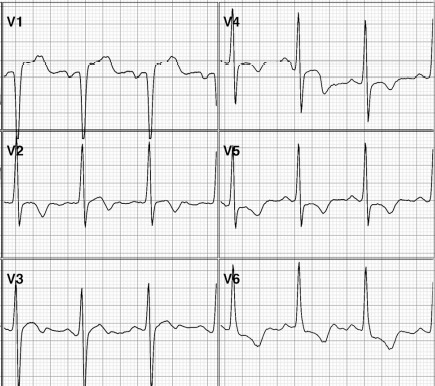 Sobrecarga ventricular esquerda - imagem ilustrativa