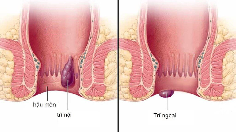 hình ảnh trĩ nội và trĩ ngoại