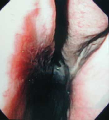 Vista endoscópica del meato caudal medio del conducto nasal izquierdo -sitio de la abertura naso-maxilar.