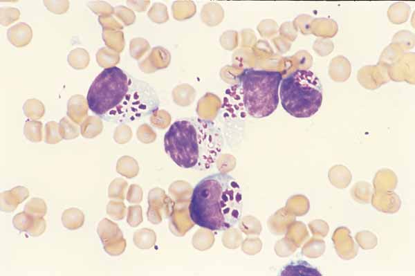 Feline atypical lymphocytes. The cells are round with abundant blue cytoplasm, large discrete irregular purple cytoplasmic granules, and oval nuclei with clumped chromatin. These cells are typical of large granular lymphoma in the cat (100x).