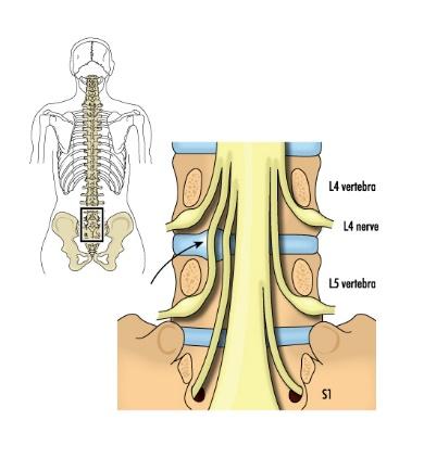 Cauda Equina Syndrome