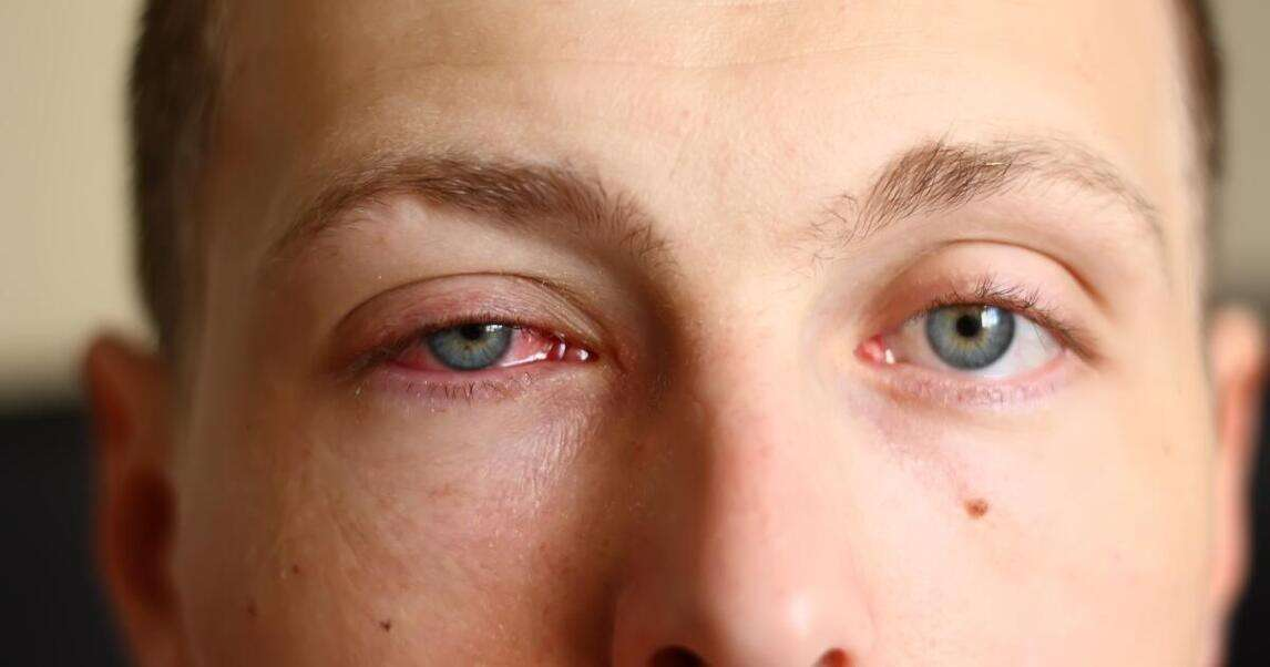Eye diseases are a common problem, but few people know what they are. This article explains the five most common eye diseases and how to manage them.
