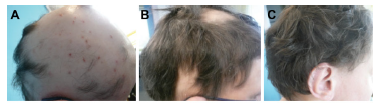 Foto Efek Zinc Gluconate