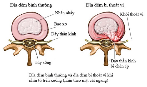 Giải phẫu đĩa đệm cột sống thắt lưng