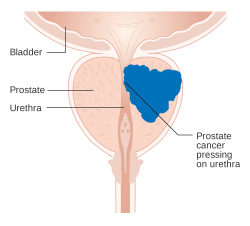 Diagram demonstrating how prostate cancer can cause urinary issues