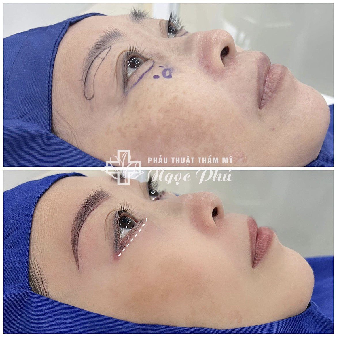 Để tìm được một cơ sở áp dụng chi phí phù hợp và đảm bảo an toàn trong quá trình thực hiện cũng như kết quả thẩm mỹ, khách hàng cần lựa chọn kỹ càng.