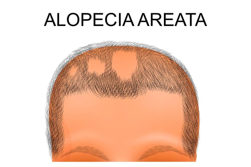 alopecia hair loss cause