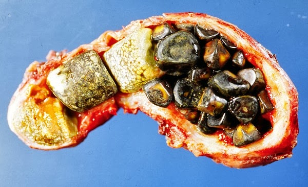 Gall Bladders opened showing Gall Stones, credit wikipedia