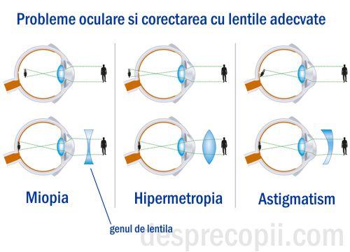 D:\Rox\Articole blog\poze\miopie astigmatism hipermetropie1.jpg