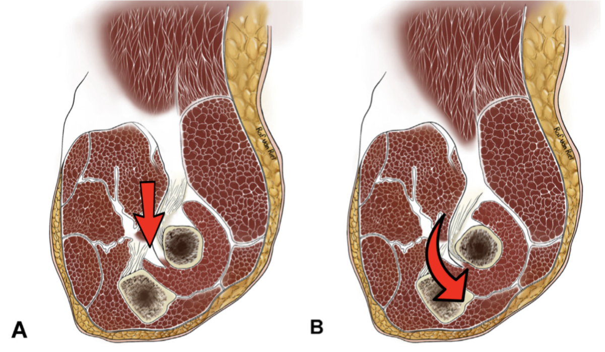 Supination Pronation Test  Distal Biceps Tendon Rupture