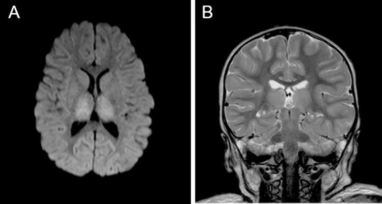 An MRI scan 162 days after the incident showed that the child still has mild residual brain injury but the cortical and white matter atrophy she suffered was nearly completely reversed.