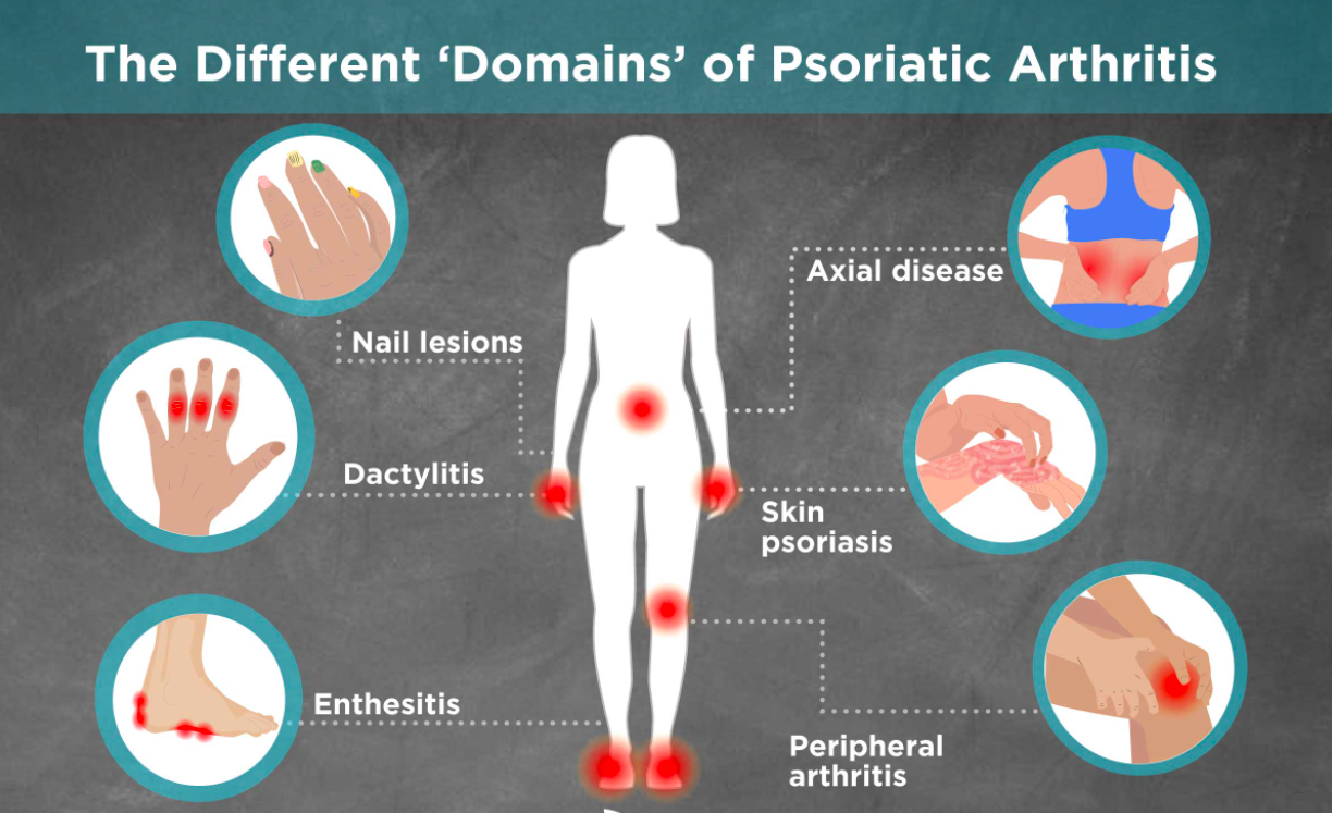 Psoriatic Arthritis - Rheumatology Advisor