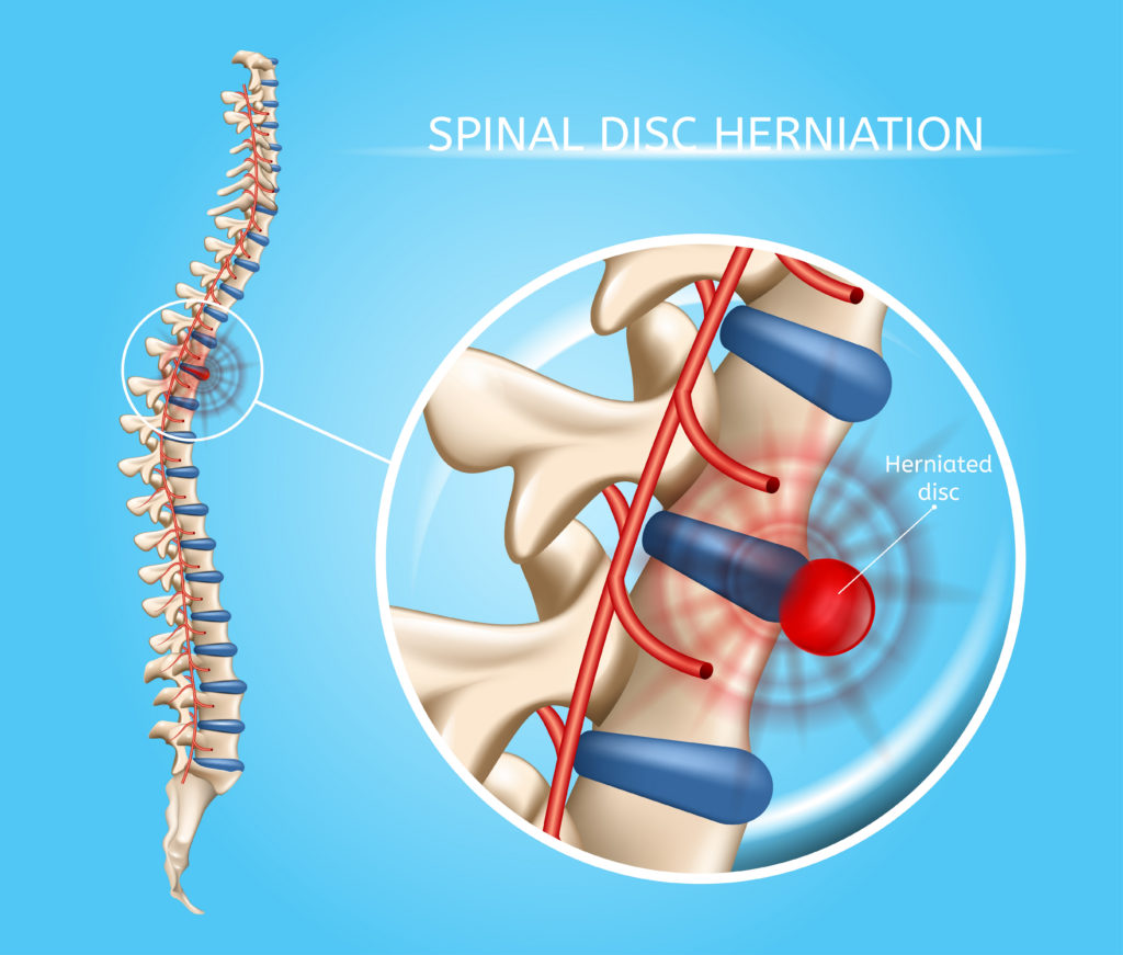 Herniated Disc Surgery: Types, Recovery Time, Risks and Benefits for Back  Pain