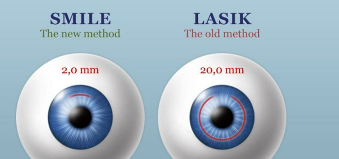 Коррекция зрения методом смайл. RELEX smile лазерная коррекция зрения. Лазерная коррекция методом Фемто ласик. Ласик Смайл коррекция зрения. Smile рефракционная операция.