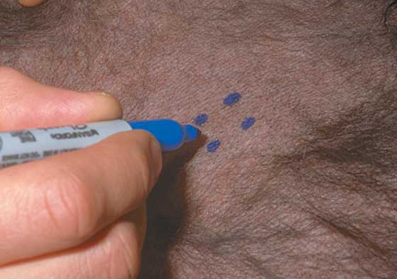 The biopsy site is gently clipped and marked with a water-proof marker pen