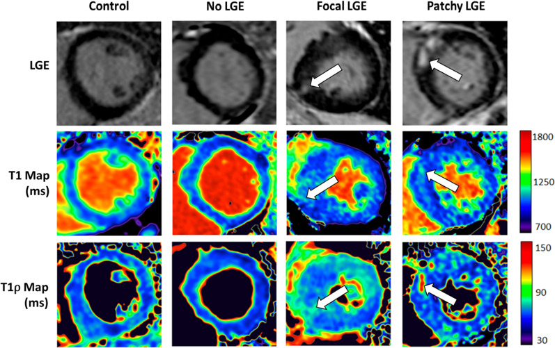 Varying levels of late gadolinium enhancement (LGE) compared to T1rho and T1 in a control and subjects with hypertrophic cardiomyopathy. Thompson et al., J Cardiovasc Magn Reson, 2021.