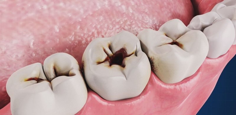 Sâu răng có lan không - nếu không được điều trị kịp thời sẽ lây nhiễm các răng xung quanh