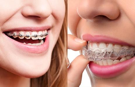 Traditional metal braces and Invisalign clear aligners Traditional metal braces and Invisalign clear aligners