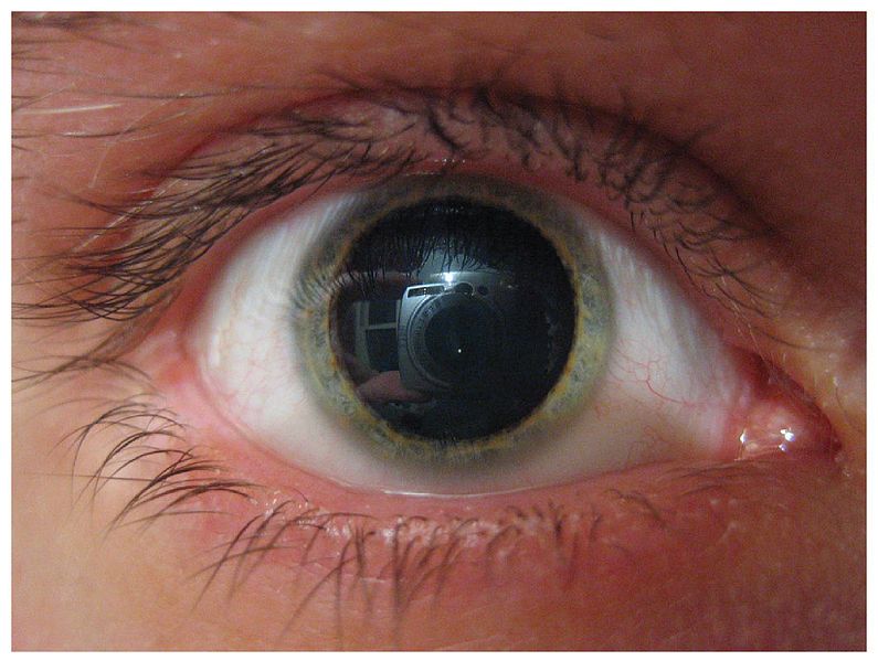 dilated pupils causes and treatments