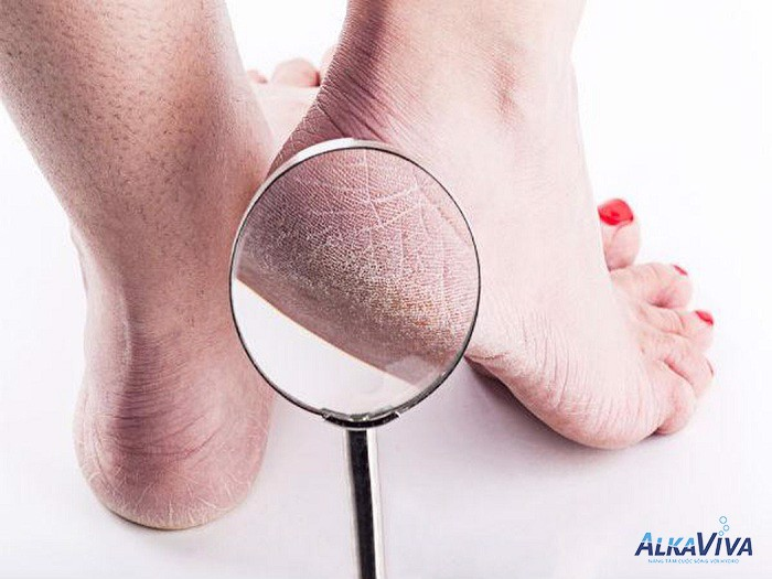 UỐNG NƯỚC ION KIỀM GIÚP GIẢM NỨT GÓT CHÂN