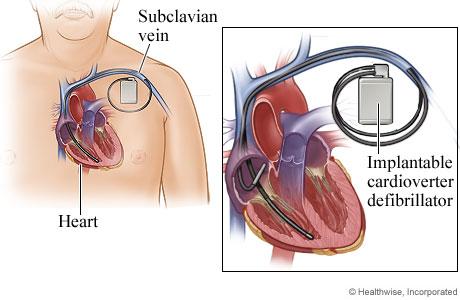 Image result for implantable defibrillator