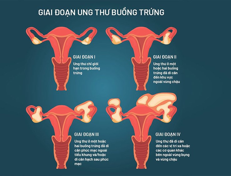 các giai đoạn ung thư buồng trứng,ung thư buồng trứng giai đoạn 1,ung thư buồng trứng giai đoạn 2,ung thư buồng trứng giai đoạn 3,ung thư buồng trứng giai đoạn cuối