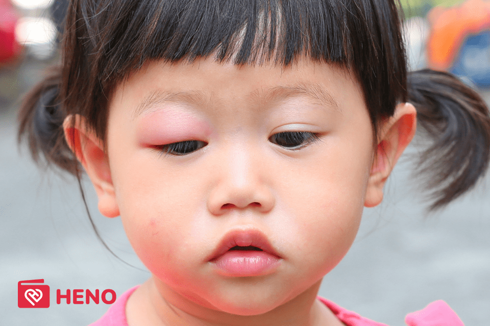 Chắp mắt không phổ biến ở trẻ em