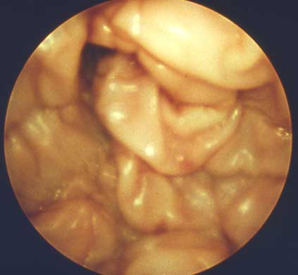 Vista cercana de unos escasos centímetros cuadrados de la mucosa vaginal canina obtenida con un endoscopio de fibra óptica durante el estro, cerca de 1 a 2 días después de la ovulación