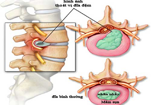 thoái hóa cột sống