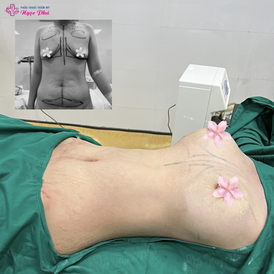 Chi phí hút mỡ bụng tại Thẩm Mỹ Việt Nam được công khai trên các diễn đàn