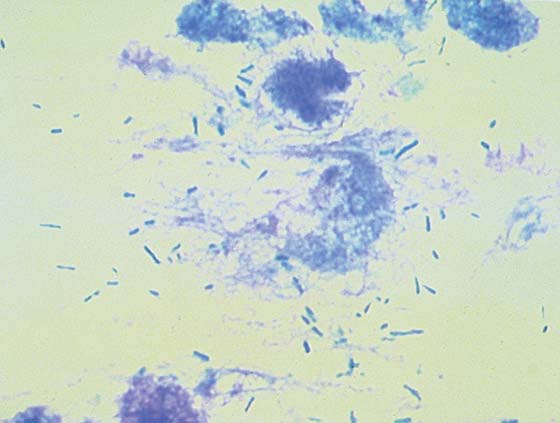 Rods on an impression smear obtained from otitis externa and stained with DiffQuick (original magnification x1000)