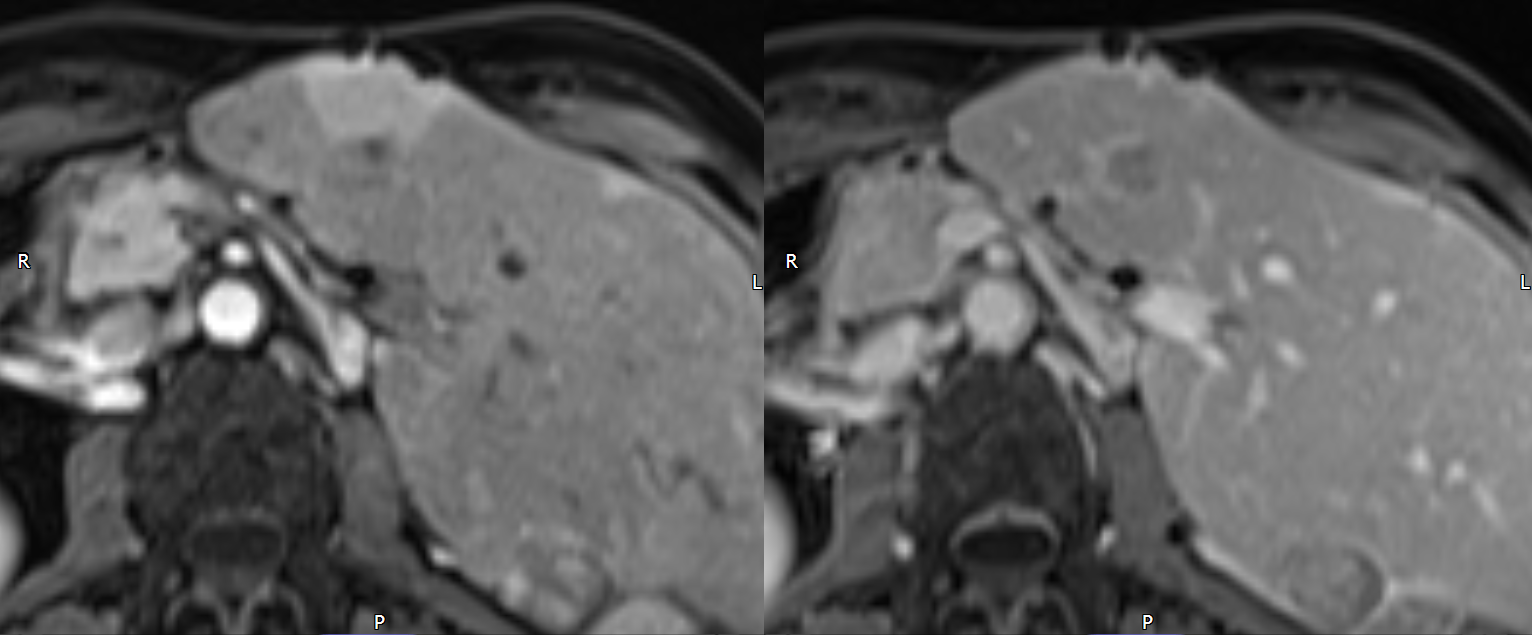 Transient hepatic intensity defect (THID) caused by liver metastasis