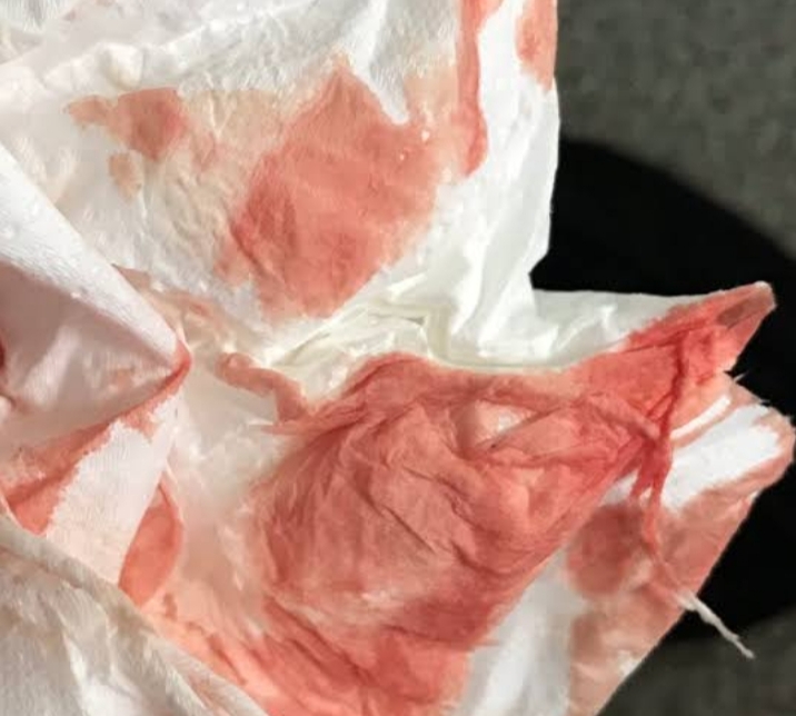 real pictures of heavy implantation bleeding
