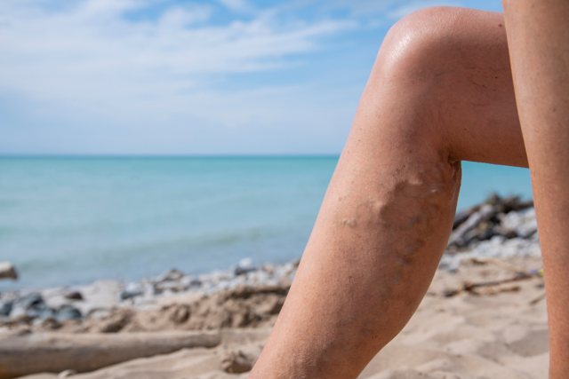 Up close image of legs with varicose veins on beach in the sand